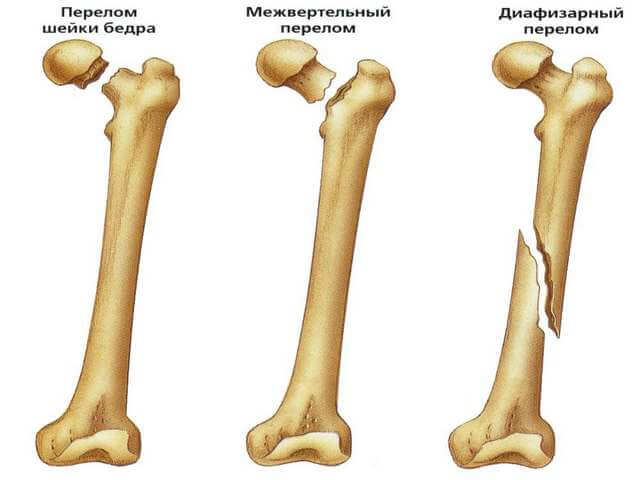 Разновидность травмы кости