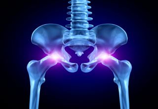 Перелом бедра: чрезвертельный перелом бедренной кости, перелом тазобедренной кости в пожилом возрасте, помощь