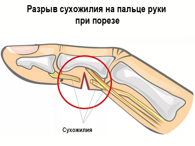Разрыв сухожилия на пальце руки лечение и симптомы