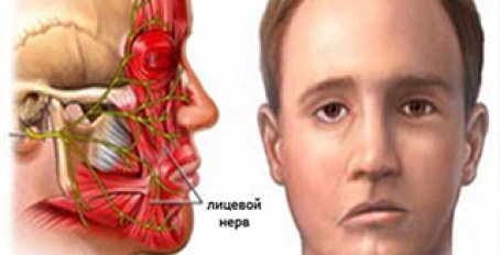 Как лечить защемление лицевого нерва