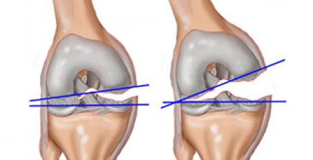 Способы лечения разрыва мениска коленного сустава