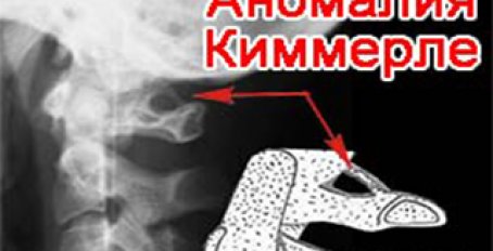 Аномалия киммерле — лечение и симптомы болезни