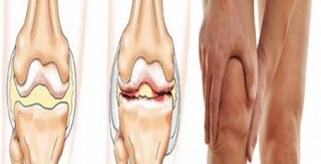 Как лечить повреждение мениска коленного сустава