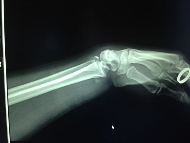 Снимок повреждения кости на руке