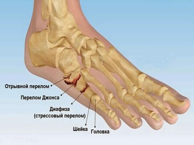 Виды переломов костей ноги