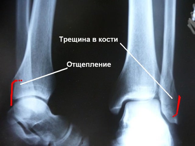 Рентген повреждения костей ног 