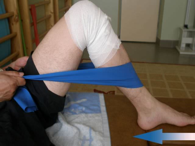 Вывих коленного сустава лечение