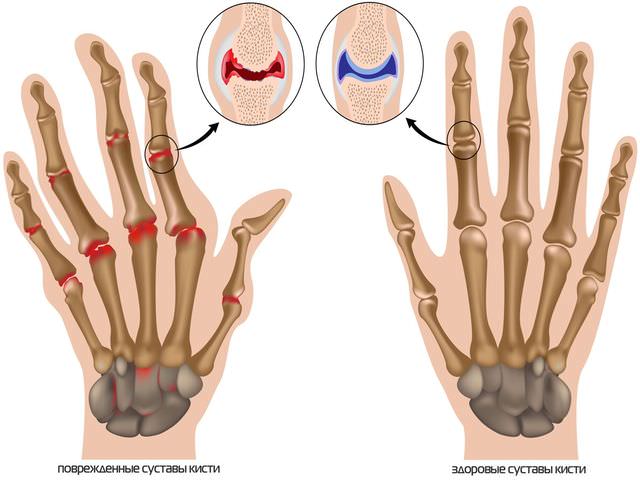 остеоартроз пальцев рук