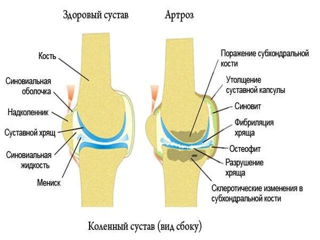 Сколько принимать при суставах. Остеоартроз синовиальная жидкость. Толщина суставного хряща коленного сустава. Толщина суставной щели коленного сустава в норме. Синовиальная жидкость при остеоартрозе.