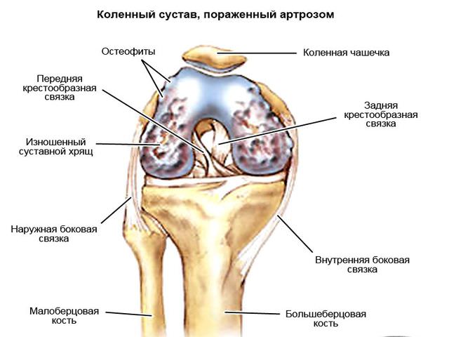 коленный сустав пораженный артрозом