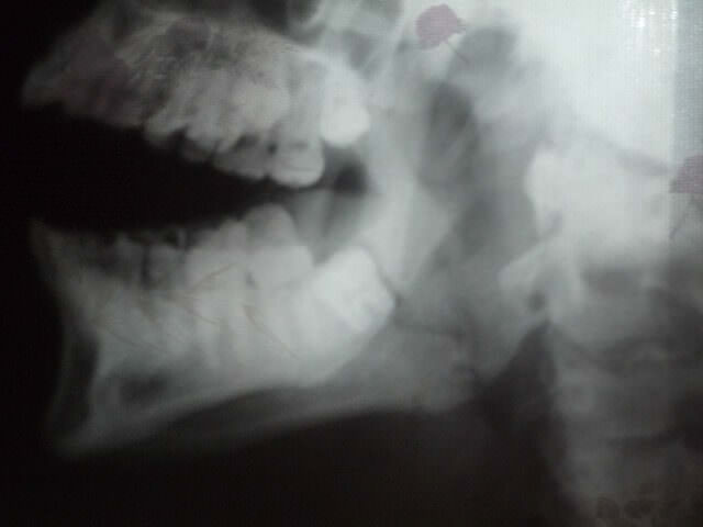 Рентгеновский снимок челюсти