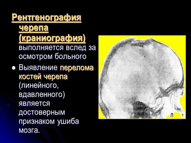 Диагностика перелома черепа thumbnail