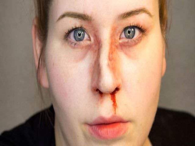 Фото после перелома носа thumbnail