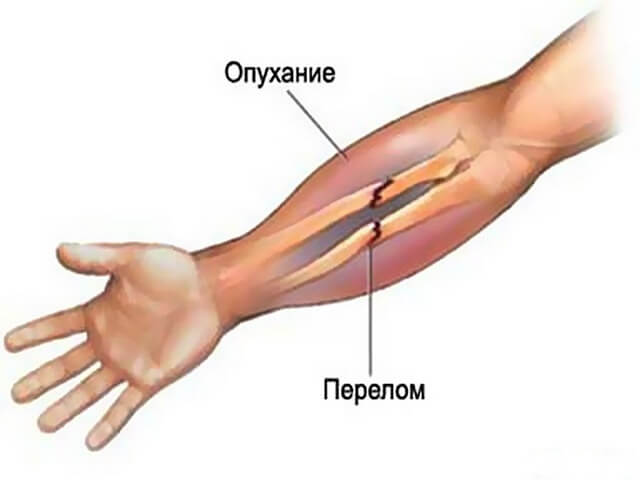 Перелом лучевой кости на руке