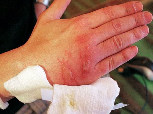 Повреждение кожи руки