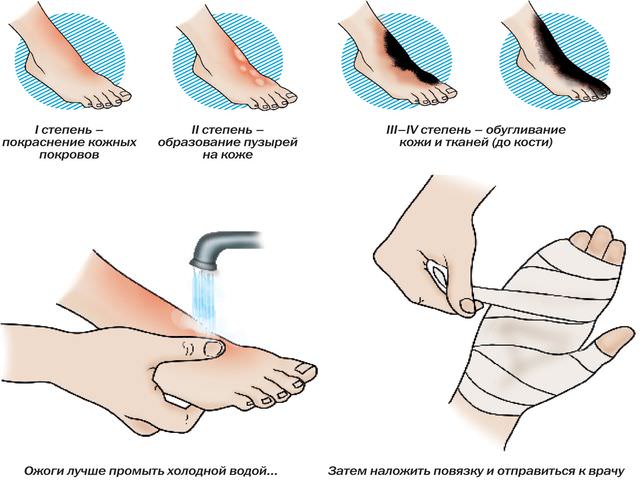 Повреждение тканей рук и ног