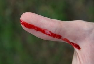Как правильно обработать рану в домашних условиях