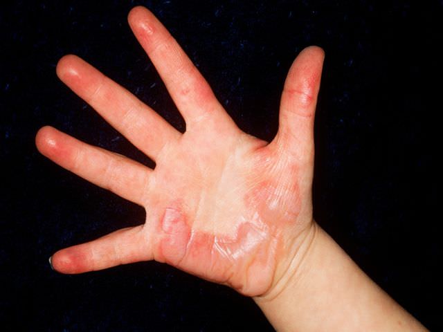 Сильное повреждение кожи руки
