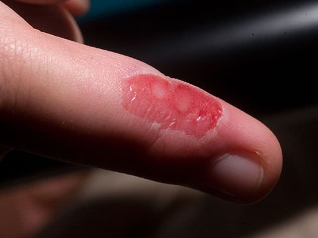 Ожоги на пальчиках у ребенка thumbnail