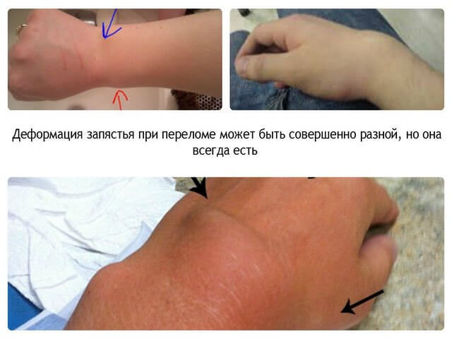 Перелом кисти руки со смещением лечение срок срастания thumbnail