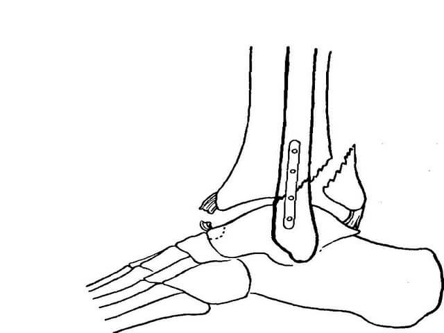 Разрабатываем ногу после операции. Репозиция перелома лодыжек. ЛФК при переломе лодыжки после операции с пластиной. Репозиция латеральной лодыжки. Репозиция отломков лодыжки.