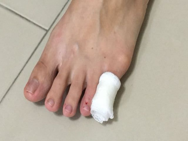 Симптомы ушиба среднего пальца на ноге thumbnail