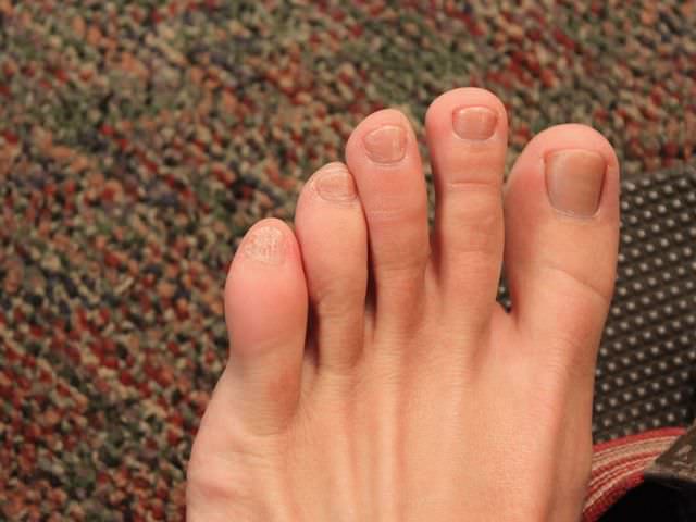 Фото ушиб большого пальца ноги thumbnail