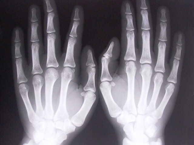Рентгеноскопический снимок