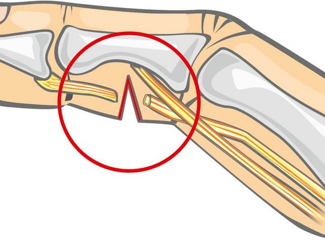 Восстановительные процедуры после перелома лучевой кости thumbnail