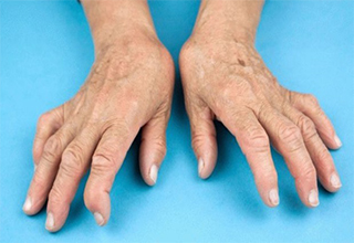 Чем лечить артрит пальцев рук