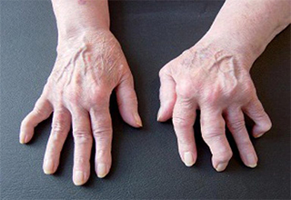 Лечение полиартрита пальцев рук народными средствами