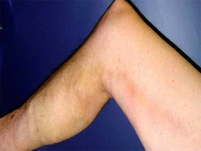 Болит икроножная мышца на правой ноге в состоянии покоя thumbnail