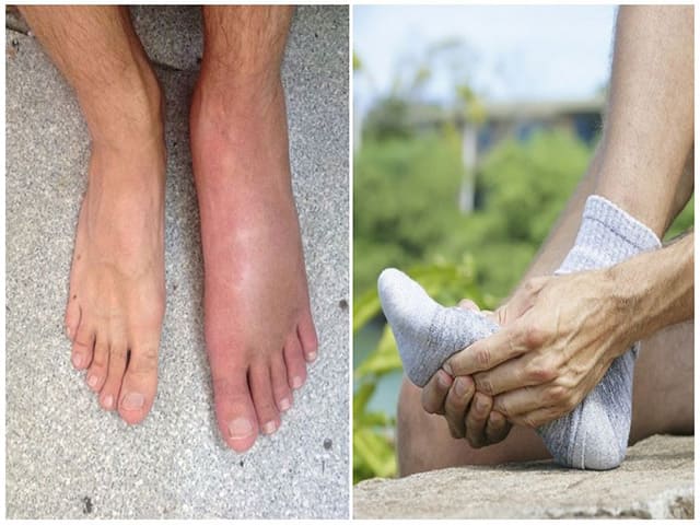 Чем лечить артрит суставов стопы