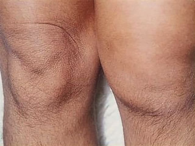 Изображение - Опухло колено и болит сустав koleno_opuhlo2
