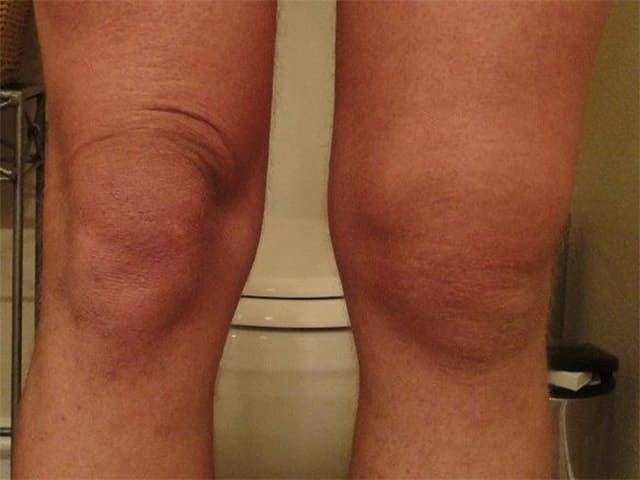 Изображение - Опухло колено и болит сустав koleno_opuhlo3